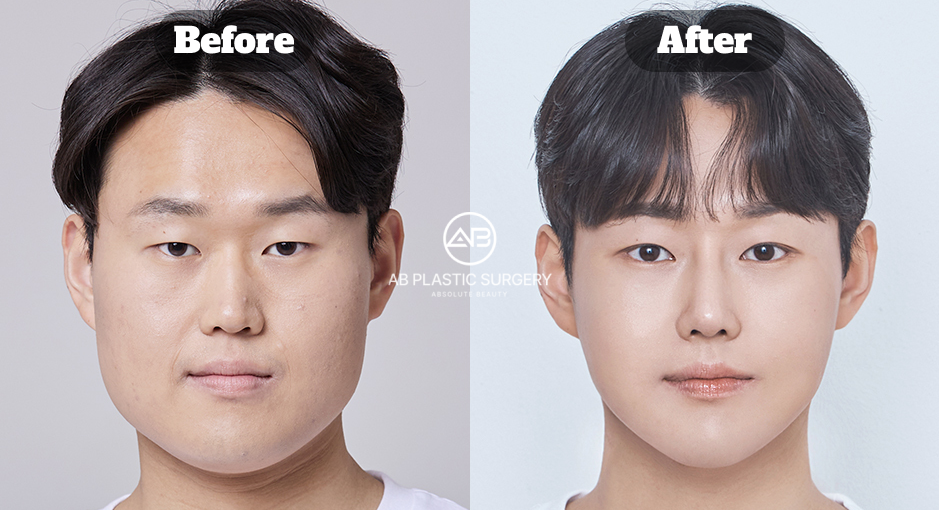 韓国の美容外科で行うエラ削り縮小・頬骨縮小・顎先縮小整形のビフォーアフターイメージ｜AB美容外科韓国