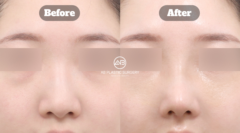 韓国で行われる曲がった鼻整形において、手術前後の写真と実際の体験レビューを通じて、鼻の歪みがどのように改善されるかを示した症例イメージ