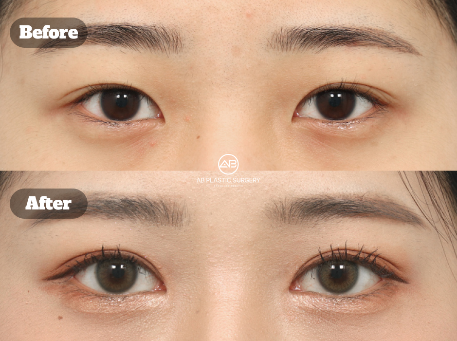 韓国で行った目元再手術と目頭切開・目尻切開・下眼瞼下制のビフォーアフター写真