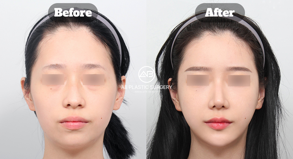 回復期間や日常生活への影響を考慮したミニVライン形成のビフォーアフター画像