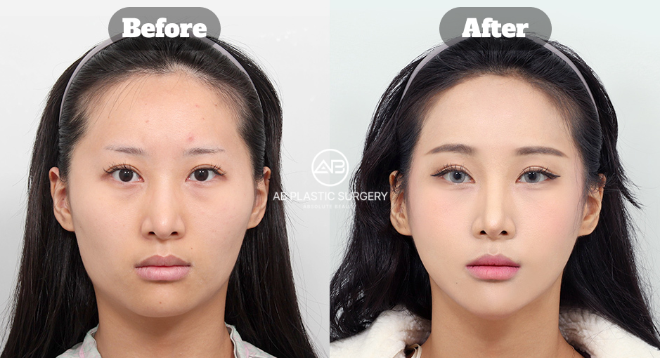 ミニVライン形成における顎先・下顎前方部を中心とした手術範囲とアプローチを示すビフォーアフター画像