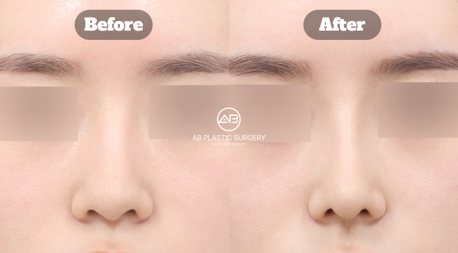 AB美容外科韓国で行われた曲がった鼻整形において、鼻の歪みと鼻唇角のバランスを同時に矯正し、正面および横顔の印象がどのように改善されたかを示す前後比較画像