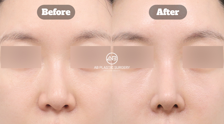 韓国で行われる鼻整形の再手術において、初回手術後に残った鼻の歪みをどのように修正し、構造的な安定性と見た目のバランスを同時に改善するかを示した症例イメージ