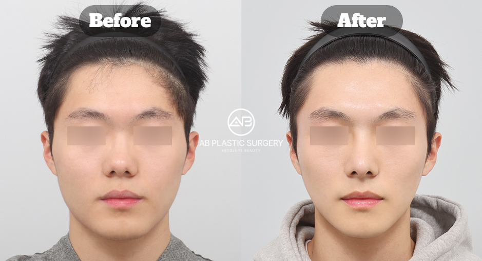 韓国の美容外科で行うエラ整形・顎先縮小整形・鼻整形のビフォーアフター写真｜AB美容外科韓国