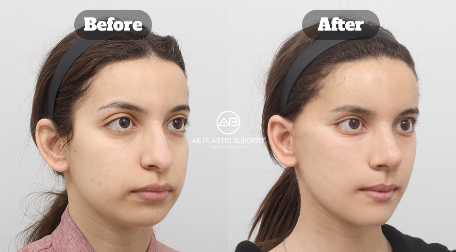 韓国AB美容外科で行ったフェイスリフティングと頬脂肪吸引の施術前後比較写真
