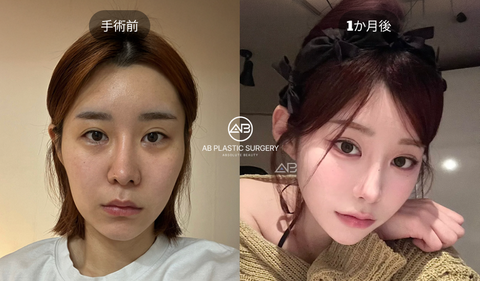 二重整形の手術前と1か月後の比較写真｜目元印象と二重ラインの変化