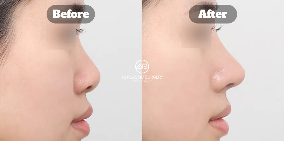 短く見える鼻に対して鼻柱を下げ鼻先を高くすることで鼻の長さを自然に延長した韓国AB美容外科の鼻整形症例