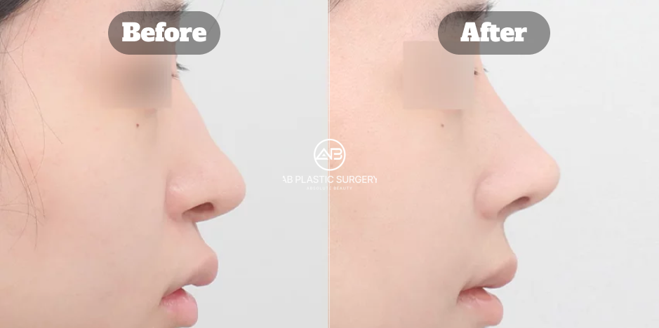 顔立ちに調和する自然な仕上がりを重視した韓国AB美容外科の鼻整形ビフォーアフター症例