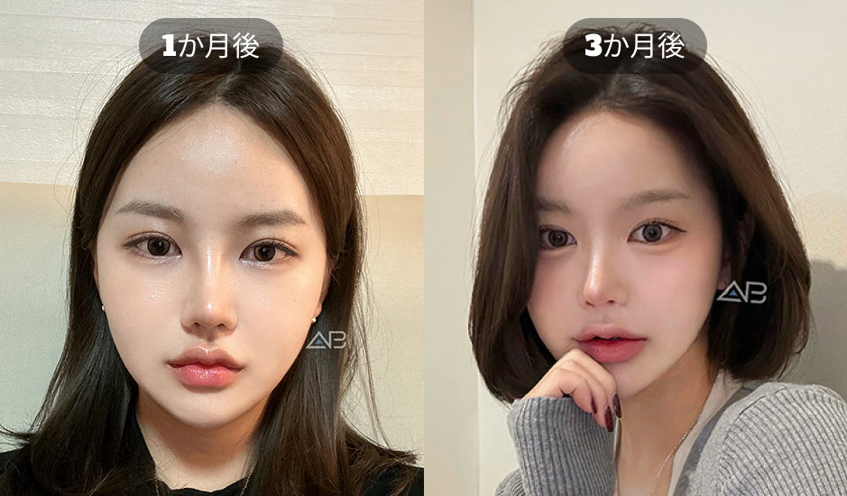 韓国AB美容外科の埋没法二重整形 1か月後と3か月後の経過写真
