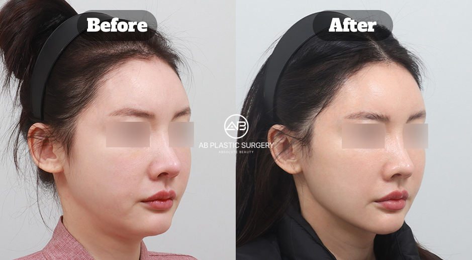 韓国AB美容外科で行った二重顎筋肉固定・脂肪吸引・唾液腺除去の施術前後写真