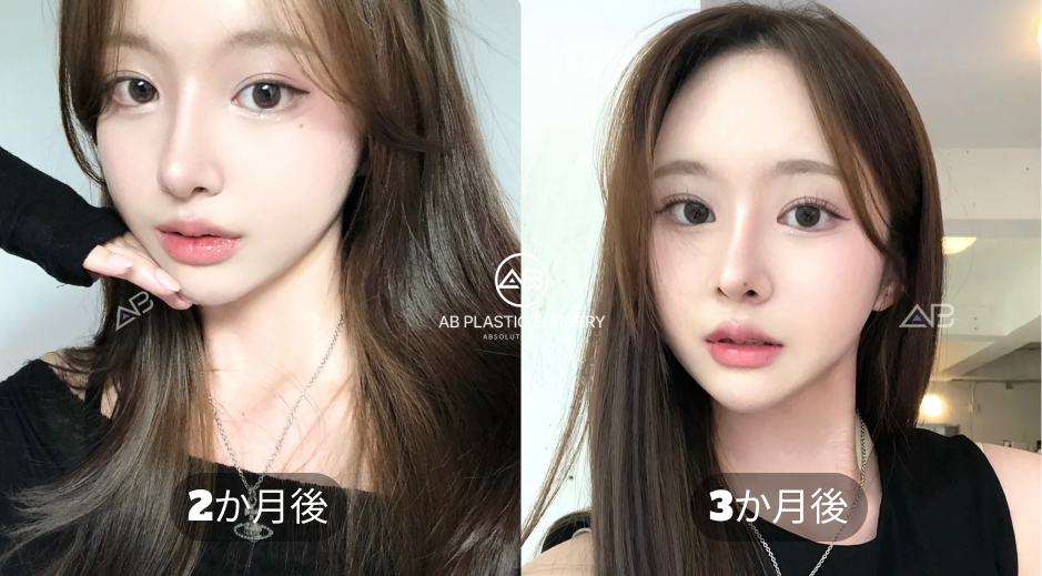 韓国AB美容外科の切開法二重整形 2か月後と3か月後の経過写真