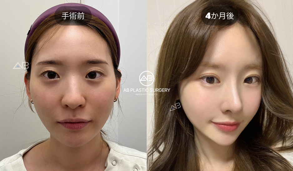 韓国AB美容外科の二重整形 手術前と4か月後の比較写真