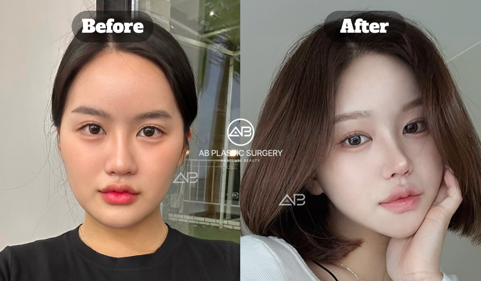 韓国AB美容外科で行った輪郭整形の施術前後比較写真