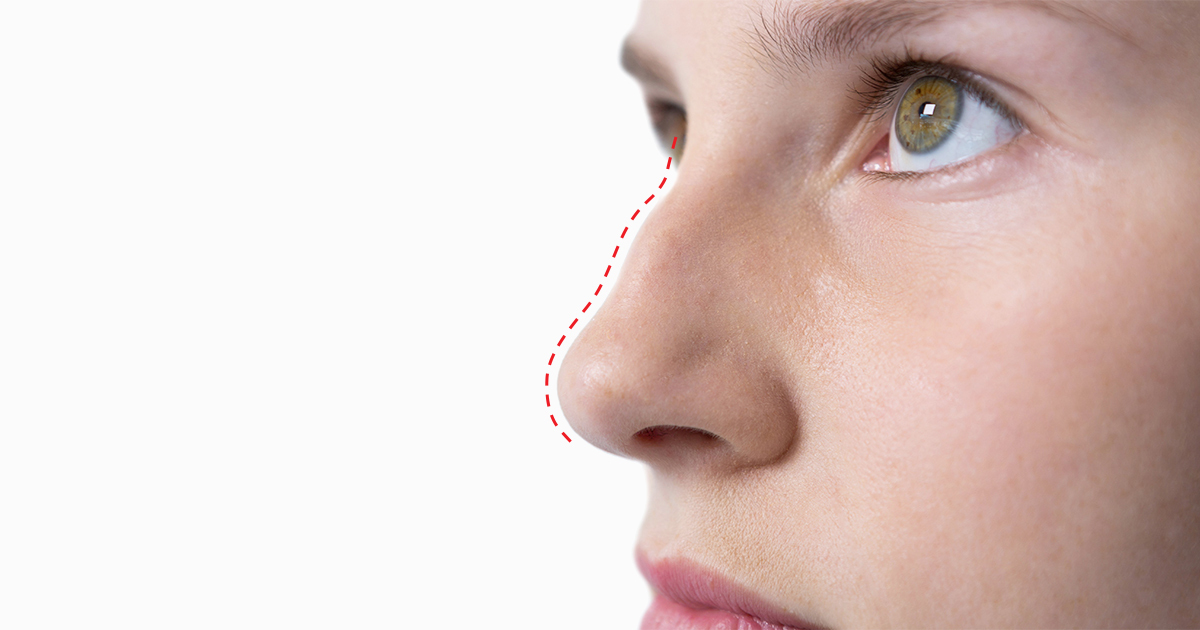 鷲鼻整形（わし鼻整形）とは？手術なしで矯正できるのか、治療方法を解説