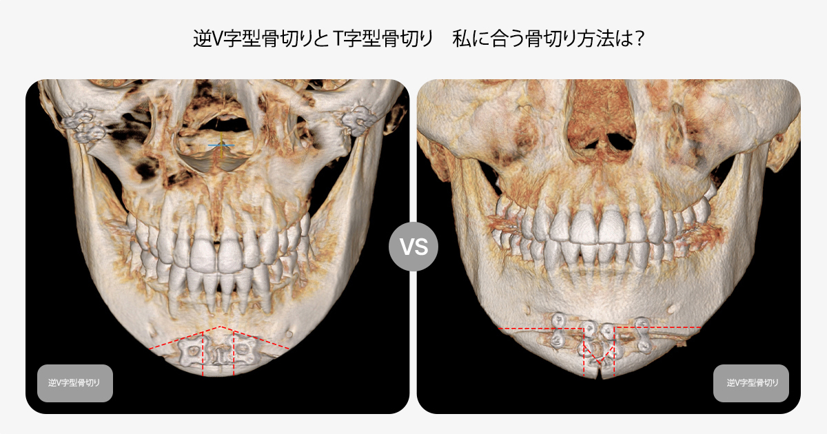 顎先手術｜T切骨と逆V字骨切りの違いとは？自分に合った切骨方法の選び方